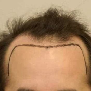 FUT Hair Transplant — before