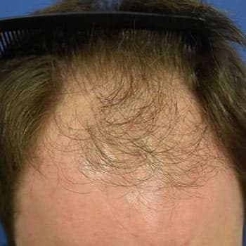 FUT Hair Transplant — before