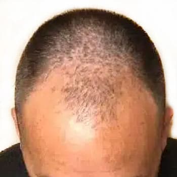FUT Hair Transplant — before