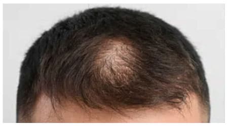 Mesotherapy — before