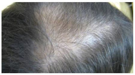 Mesotherapy — before