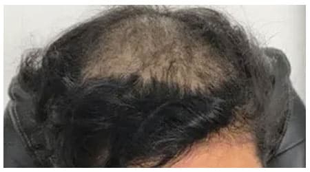 Mesotherapy — before