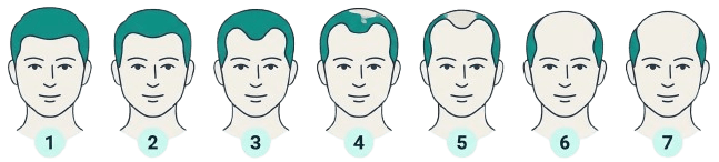 Norwood hair-loss scale, stages 1 to 7 from least to most hair loss