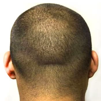 FUE — Donor Area — after