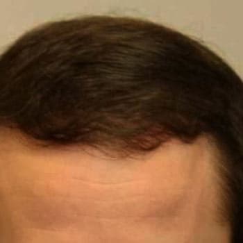 FUT Hair Transplant — after
