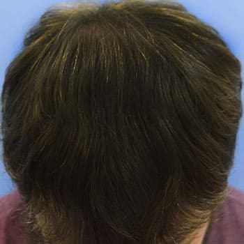 FUT Hair Transplant — after