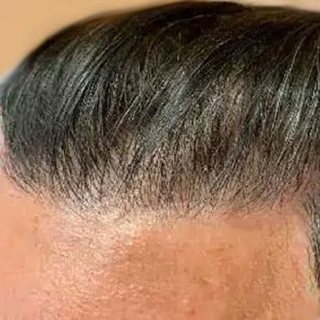 FUT Hair Transplant — after