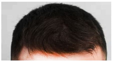 Mesotherapy — after