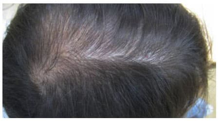 Mesotherapy — after