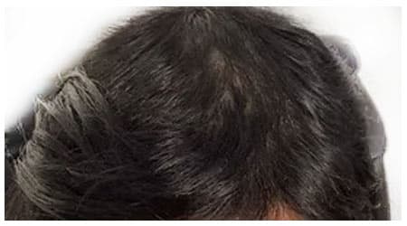 Mesotherapy — after